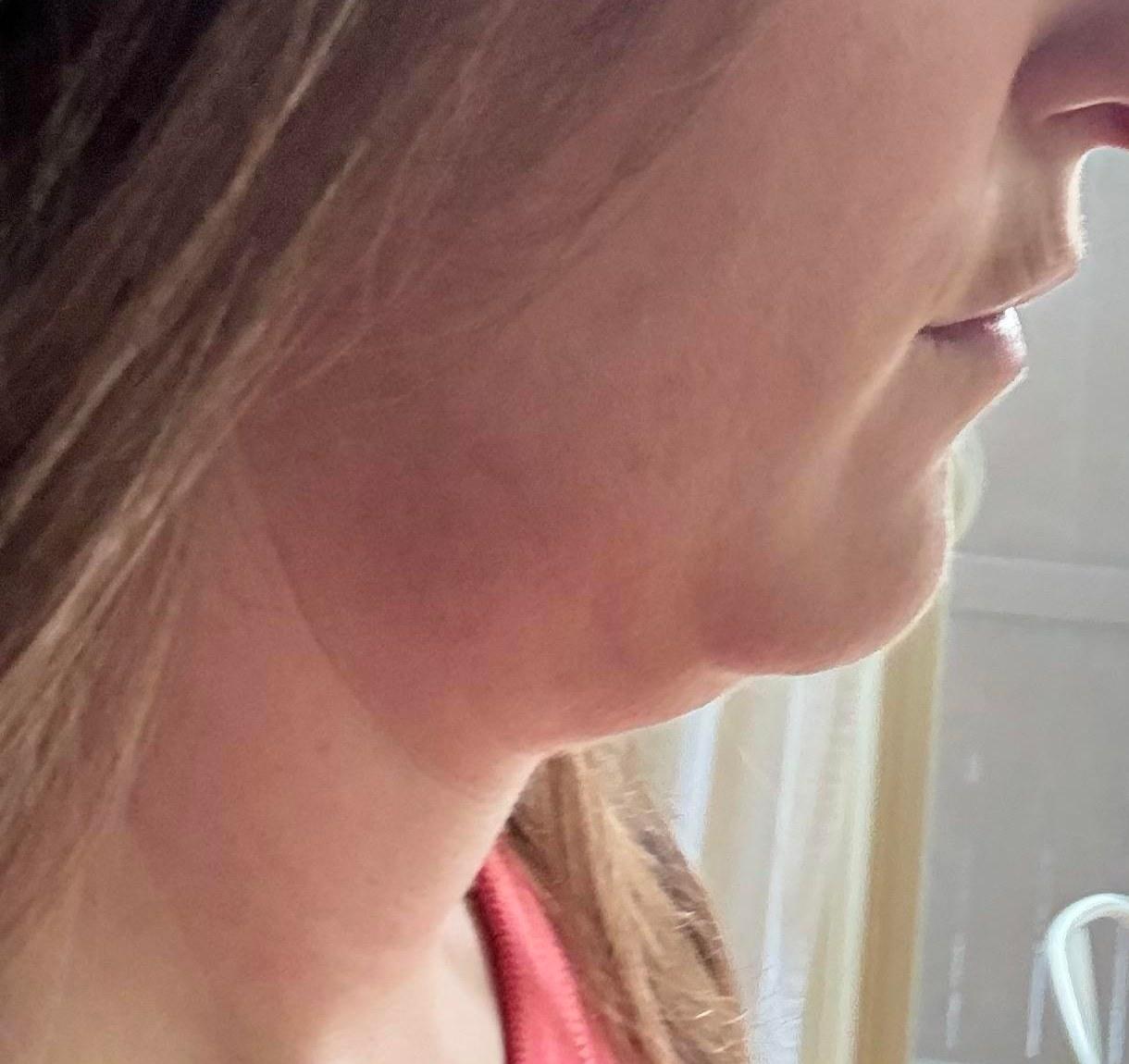 Before profile crop from a deep plane neck lift patient story