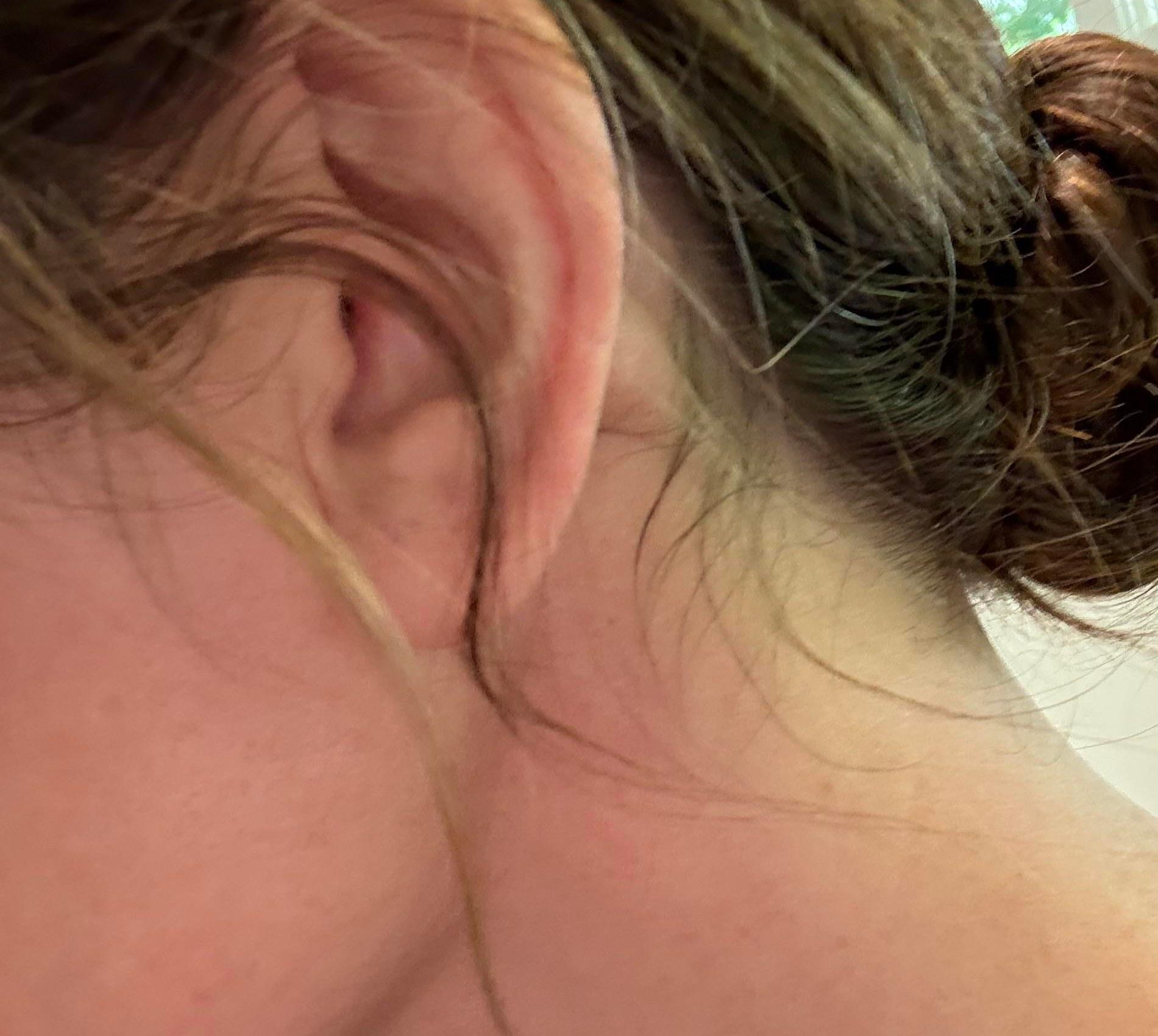 Near-ear healing detail from a deep plane neck lift patient story