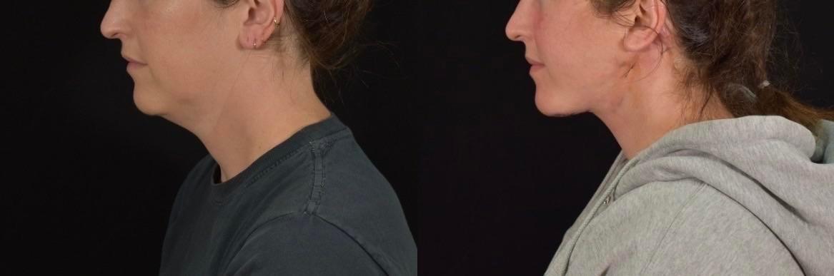 Patient-shared neck lift profile comparison at 3.5 weeks
