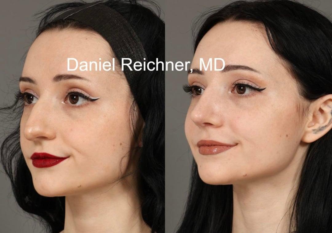Oblique comparison after first rhinoplasty and six weeks after revision