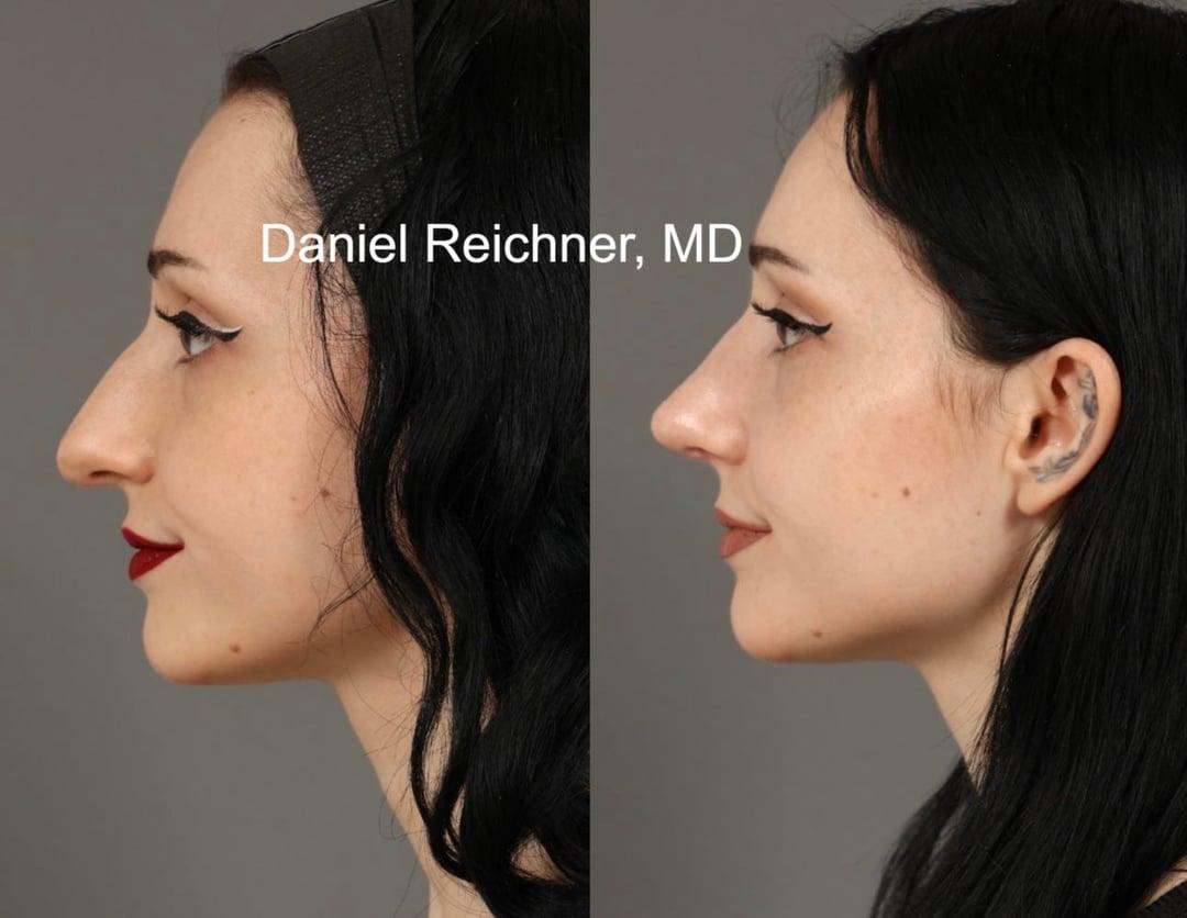 Profile comparison after first rhinoplasty and six weeks after revision