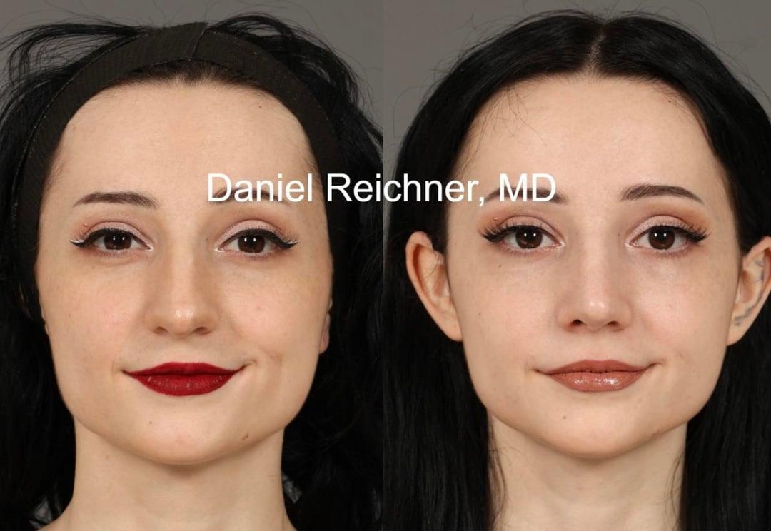 Front comparison after first rhinoplasty and six weeks after revision