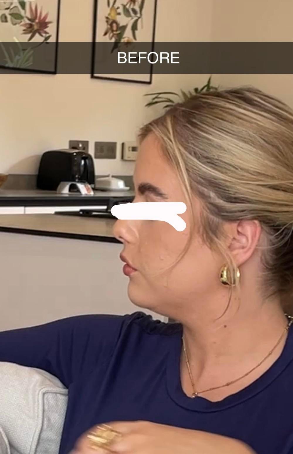 Left-profile photo labeled before by the Reddit poster