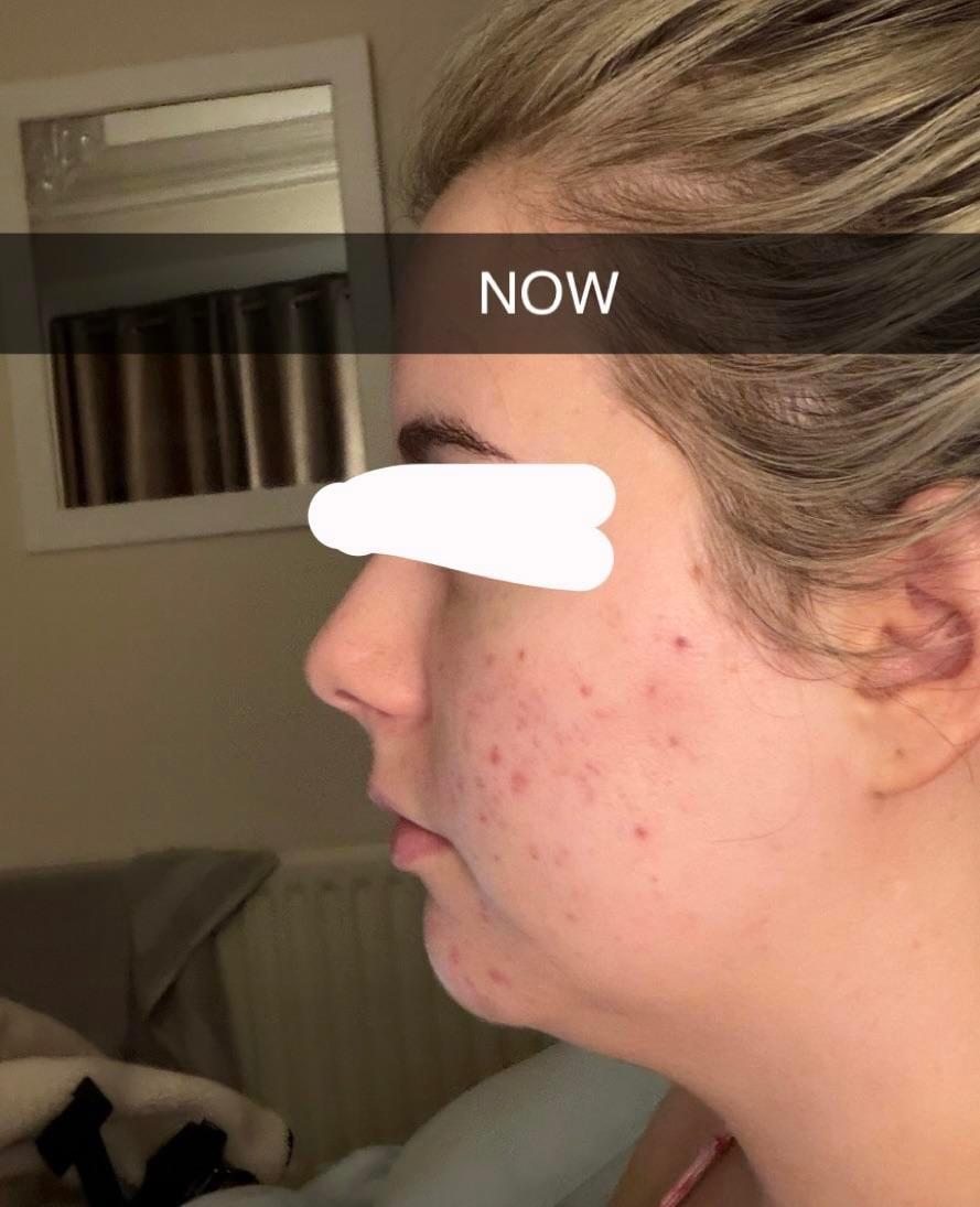 Left-profile photo labeled now at six months by the Reddit poster