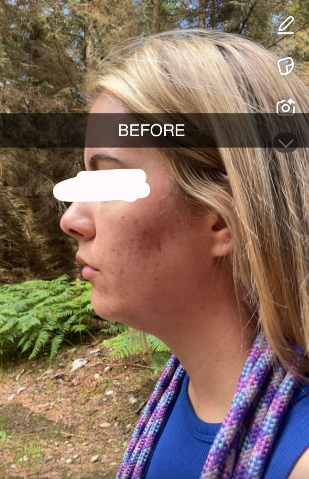 Right-profile photo labeled before by the Reddit poster