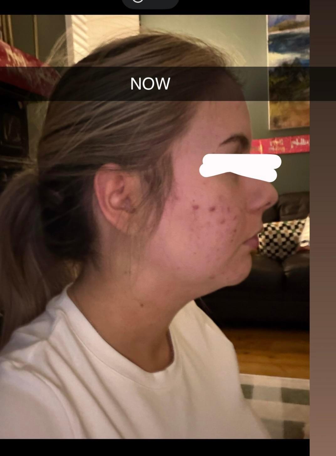 Right-profile photo labeled now at six months by the Reddit poster