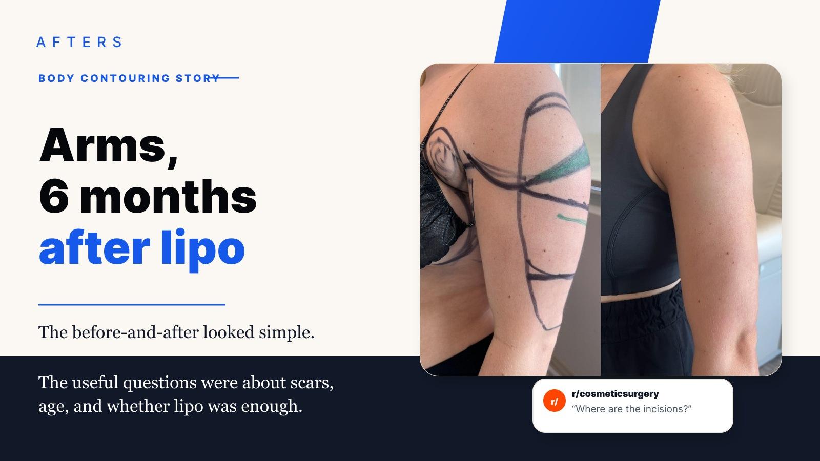 Arm Liposuction at 6 Months: The Shape Change and the Scar Questions
