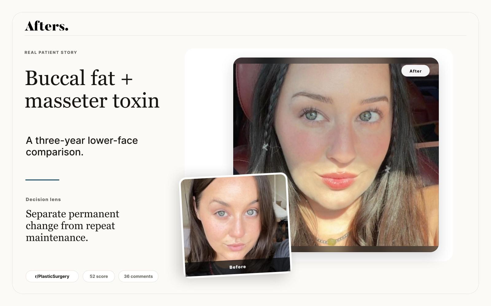 Buccal Fat Removal and Masseter Botox: When the Result Is Hard to Judge