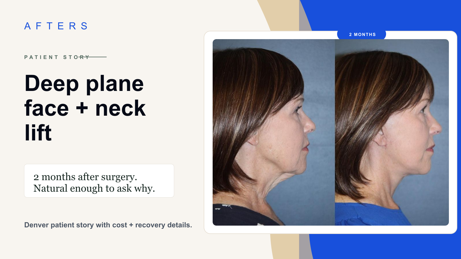 Deep Plane Face and Neck Lift in Denver: The 2-Month Result People Called Natural