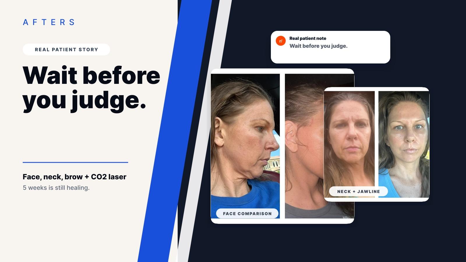 A 40-Year-Old Deep Plane Facelift Story That Felt Unusually Honest