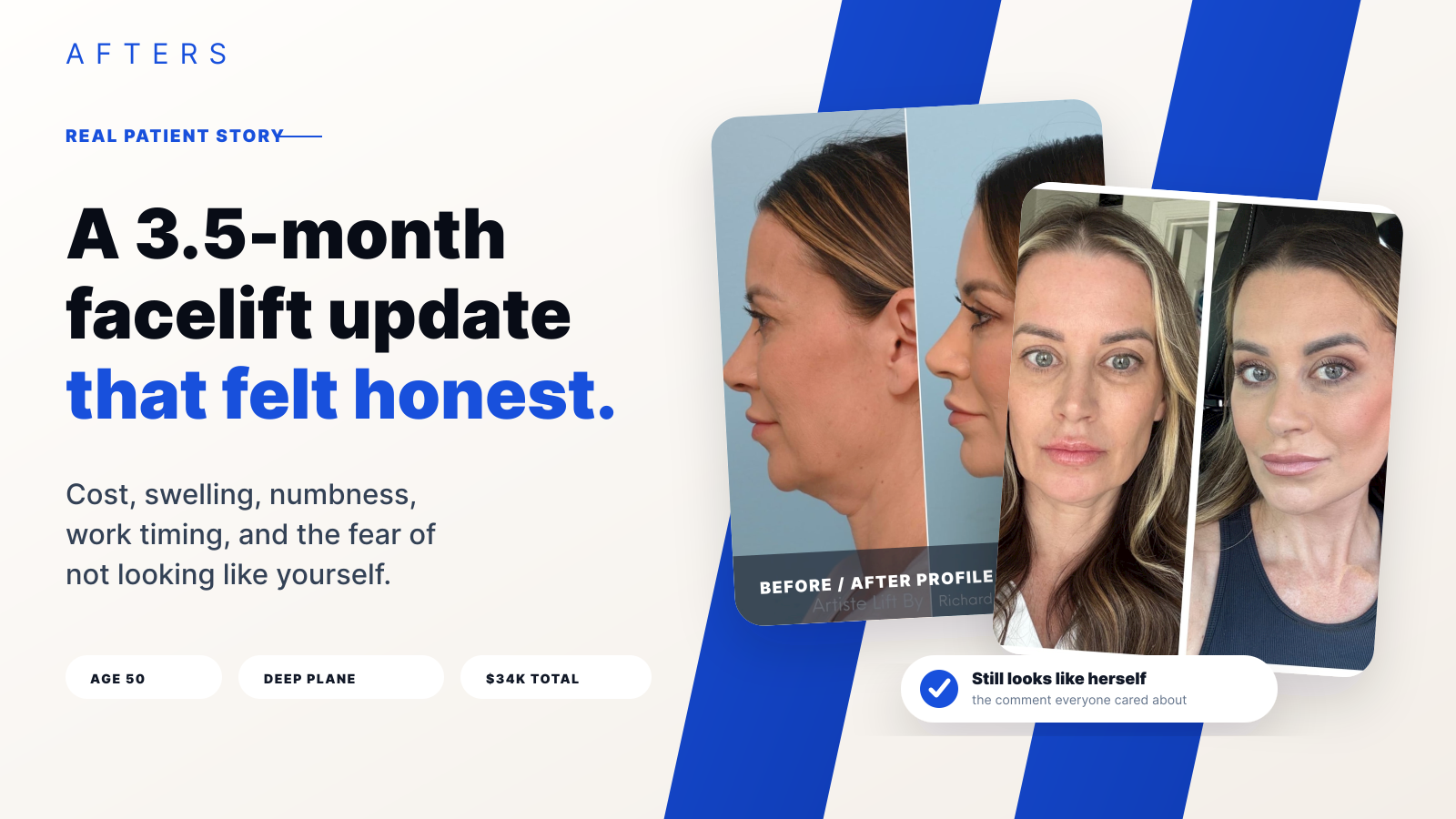 At 3.5 Months After a Deep Plane Facelift, She Still Looked Like Herself