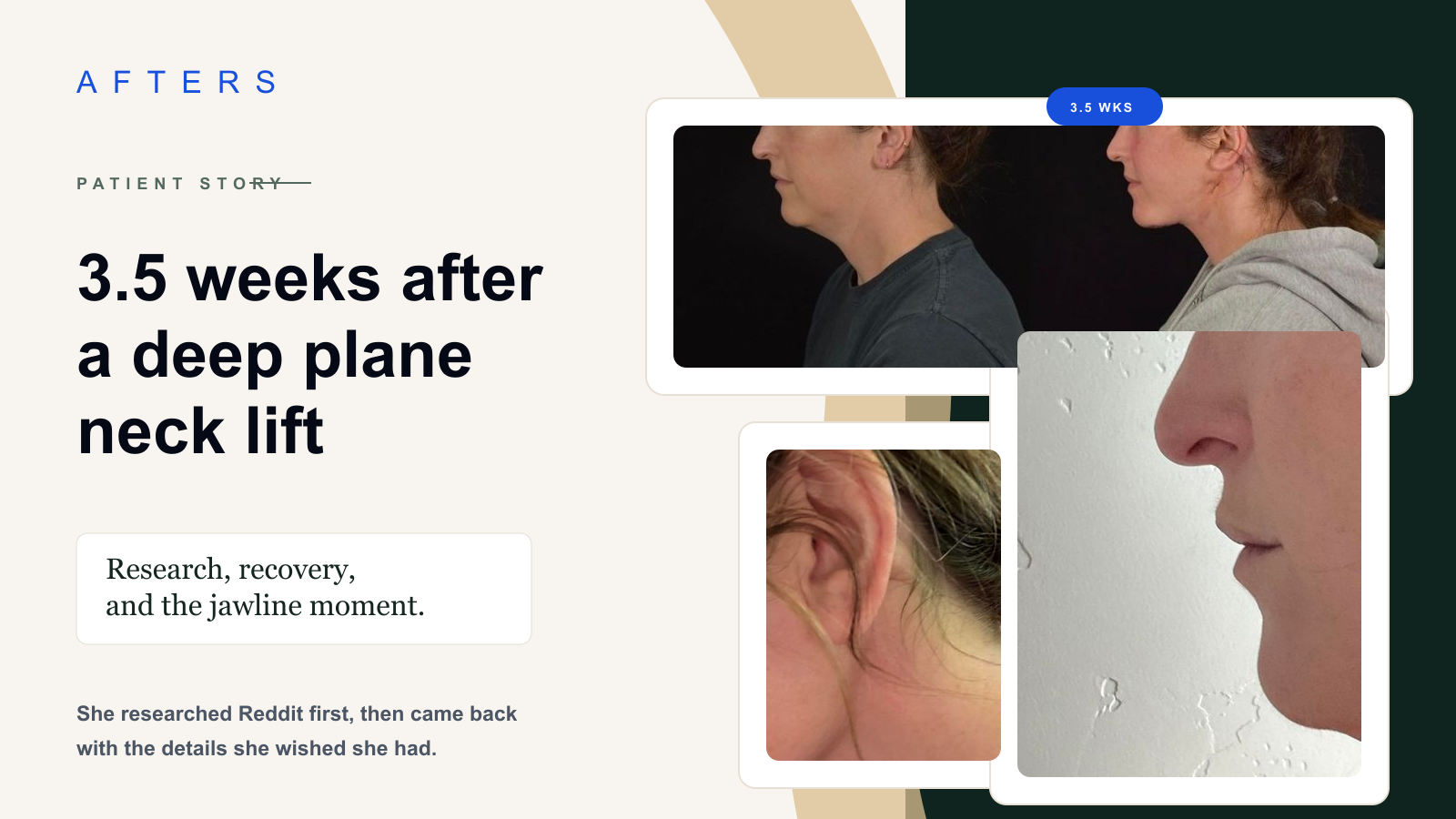 Deep Plane Neck Lift at 3.5 Weeks: The Result She Came Back to Explain