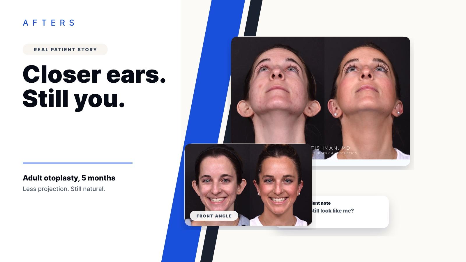 Otoplasty for Prominent Ears: The Quiet Confidence People Search For