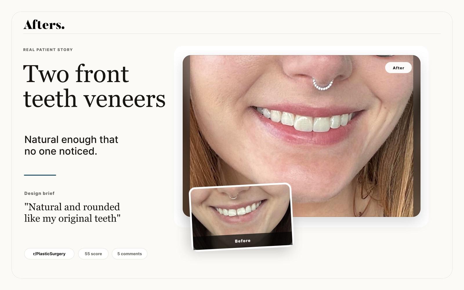 Two Front Teeth Veneers: When No One Notices, That Can Be the Win