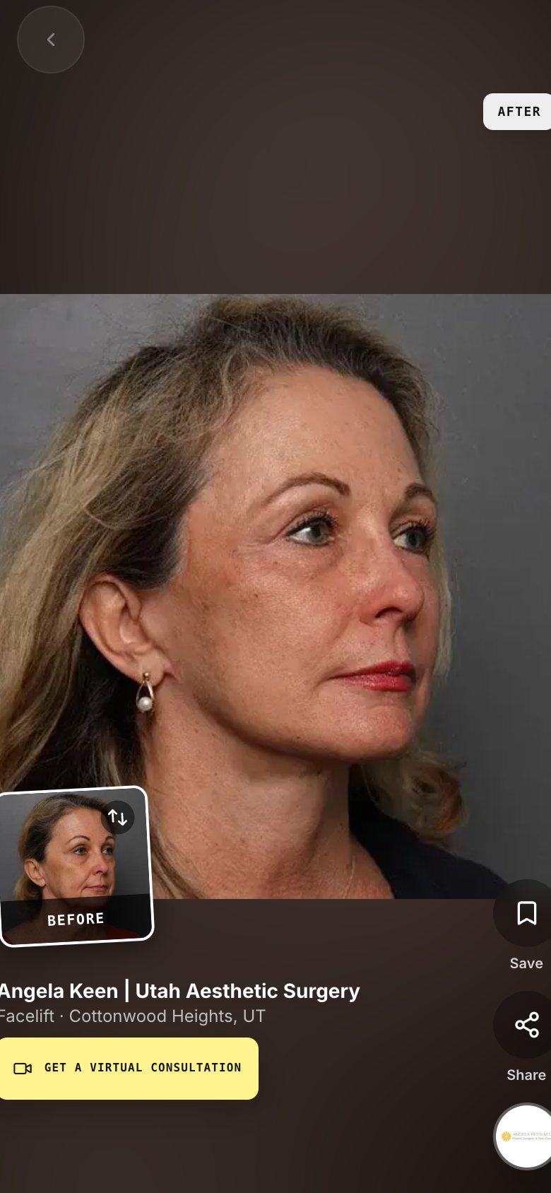 A facelift result full screen on Angela Keen | Utah Aesthetic Surgery’s page
