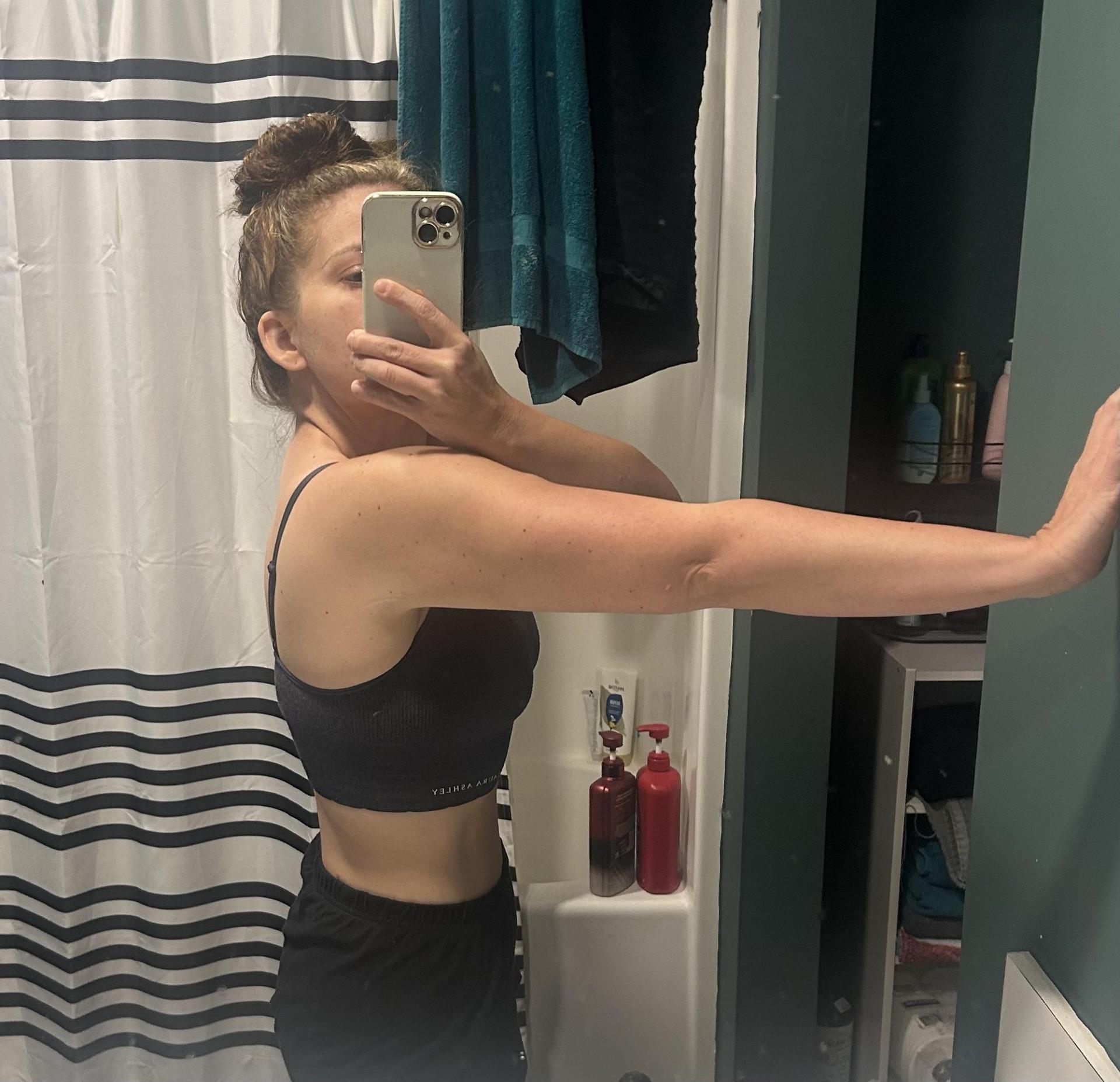 Arm Lift Scars at 1 Year: The Photos Everyone Asks Her For