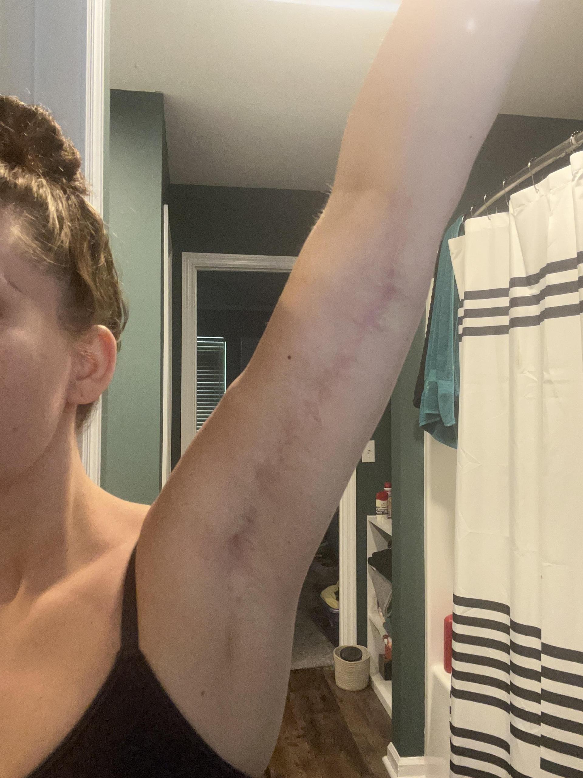 Arm raised 1 year after an arm lift showing the scar along the inner arm