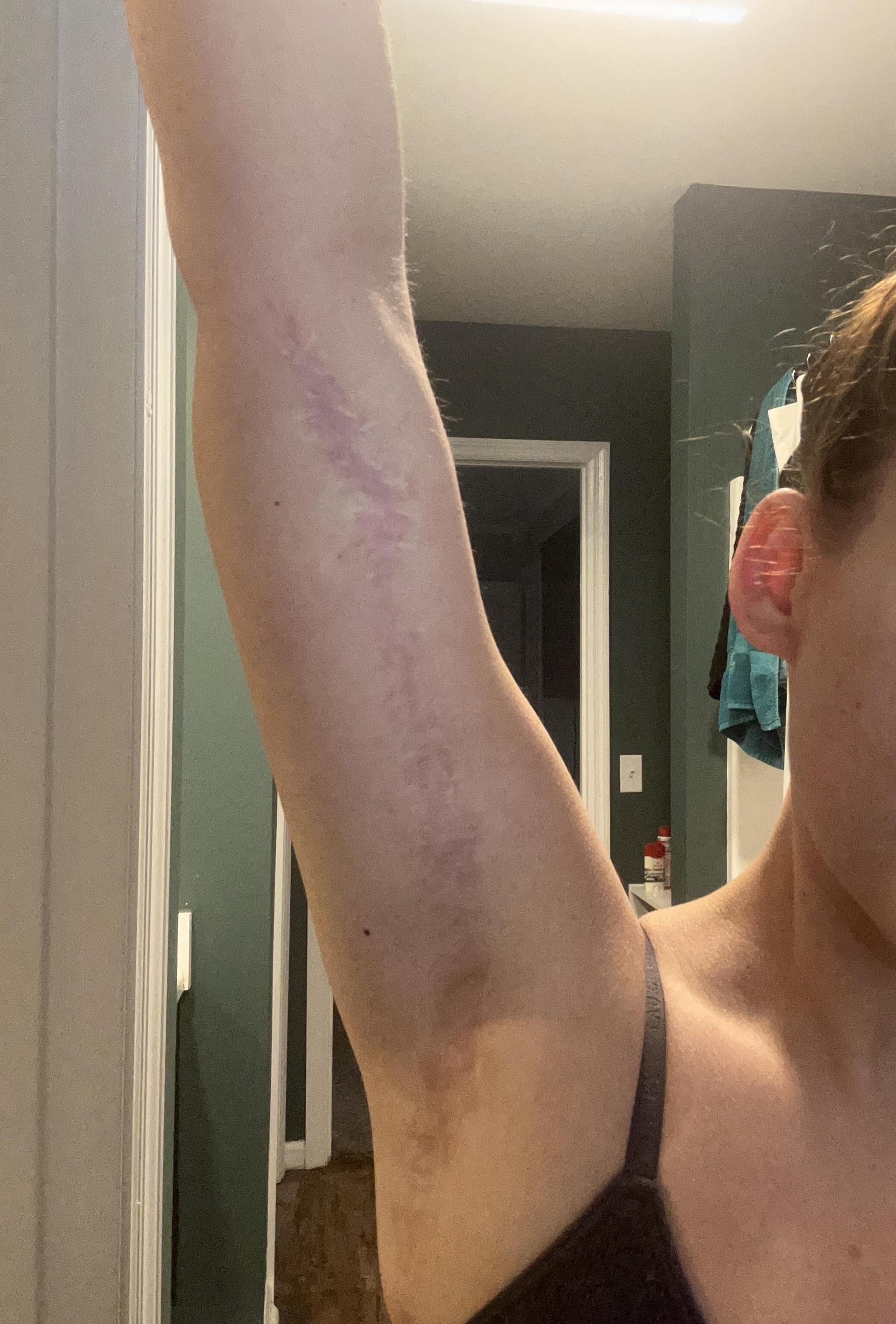 Close view of an inner-arm brachioplasty scar at almost 1 year, still pink in places