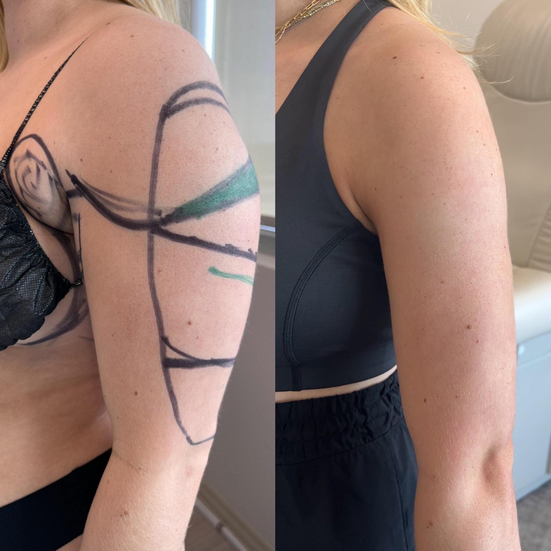 Before-and-after arm liposuction result at 6 months from a Reddit surgeon post