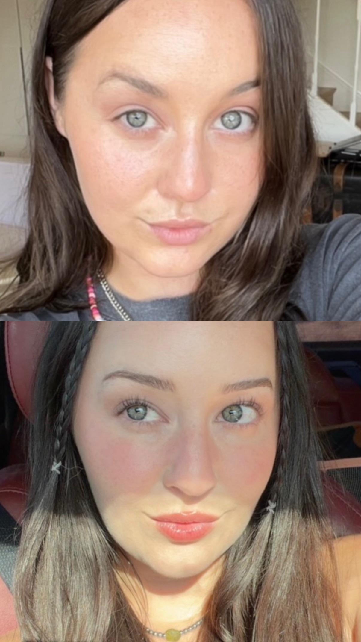 Top-before bottom-after comparison photo from the lower-face contouring Reddit post