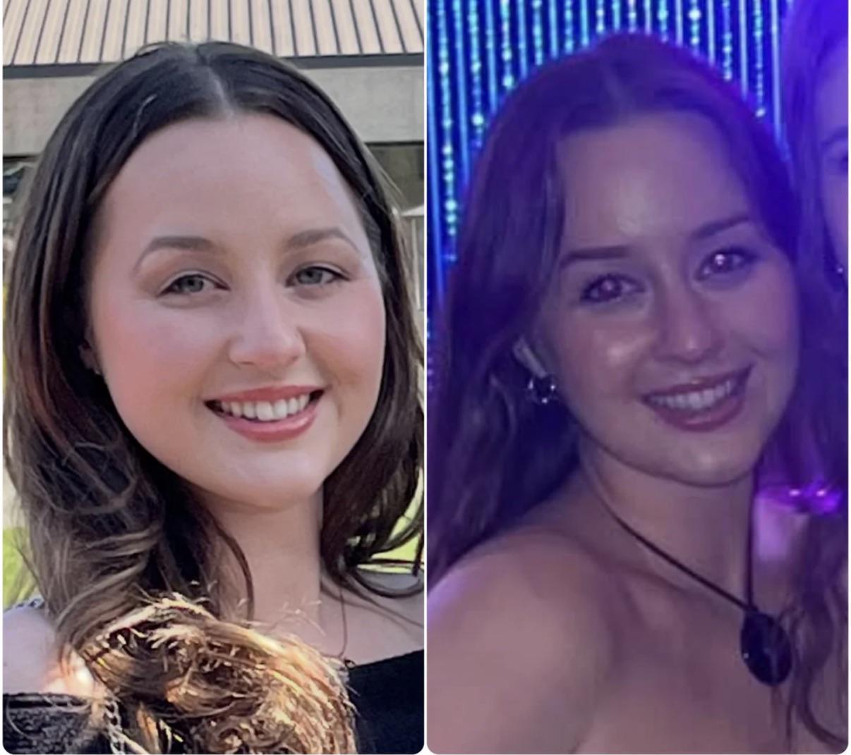 Side-by-side comparison photo from the lower-face contouring Reddit post