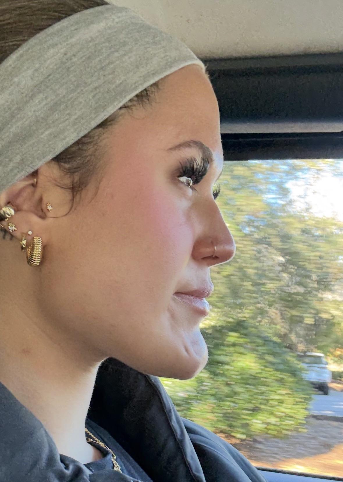Side profile before chin reduction surgery, from a public Reddit patient post