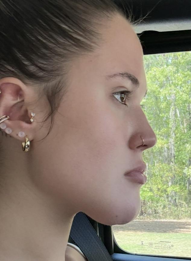 Side profile at 2 weeks after chin reduction, still visibly swollen
