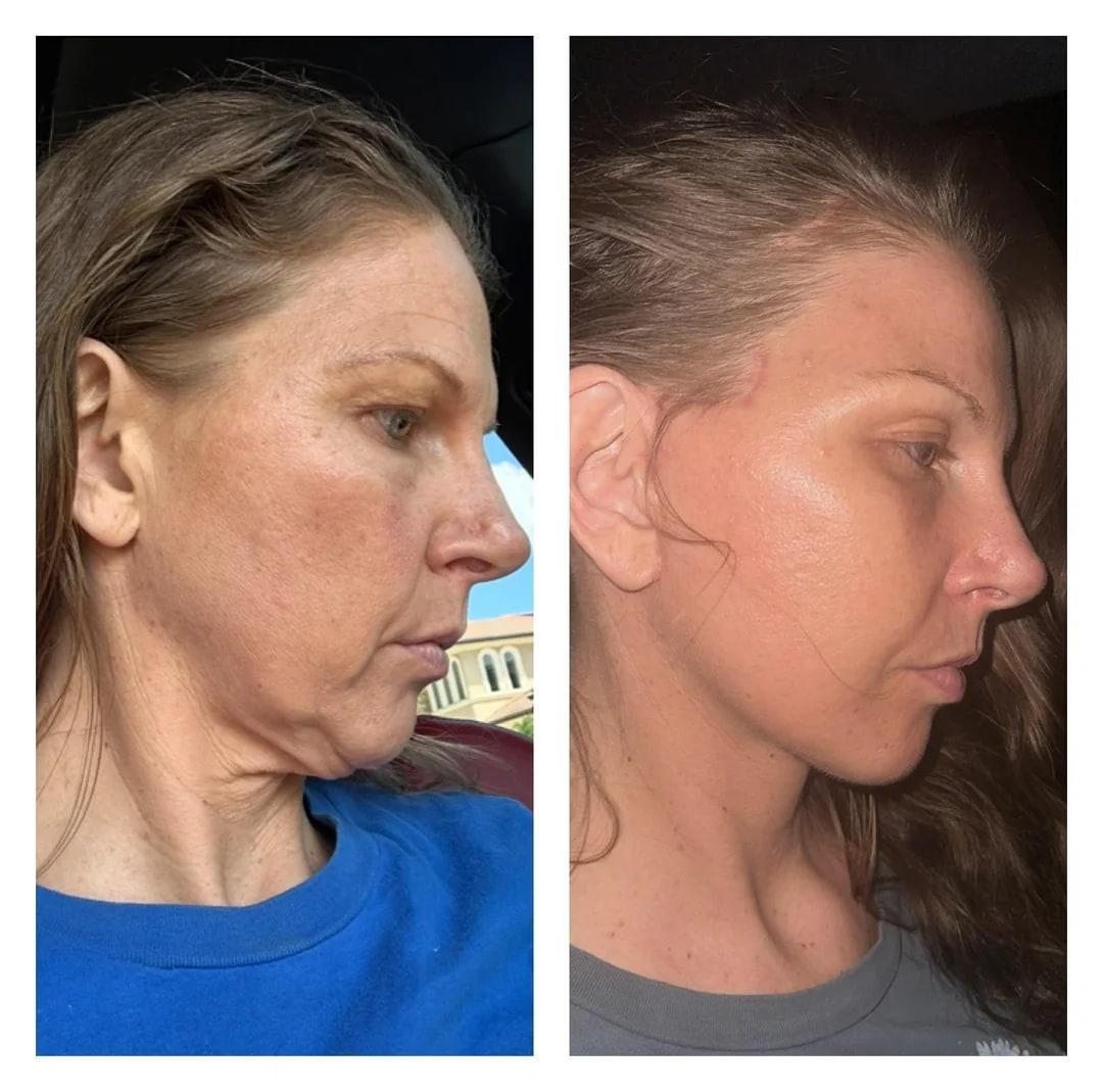 Before and after face comparison from a 40-year-old deep plane facelift patient story