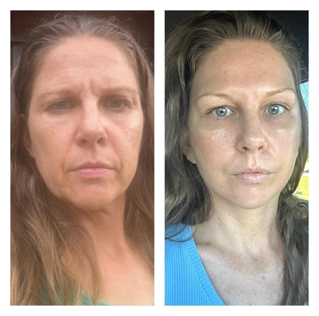 Additional before and after photo from a deep plane face and neck lift with brow lift and laser resurfacing