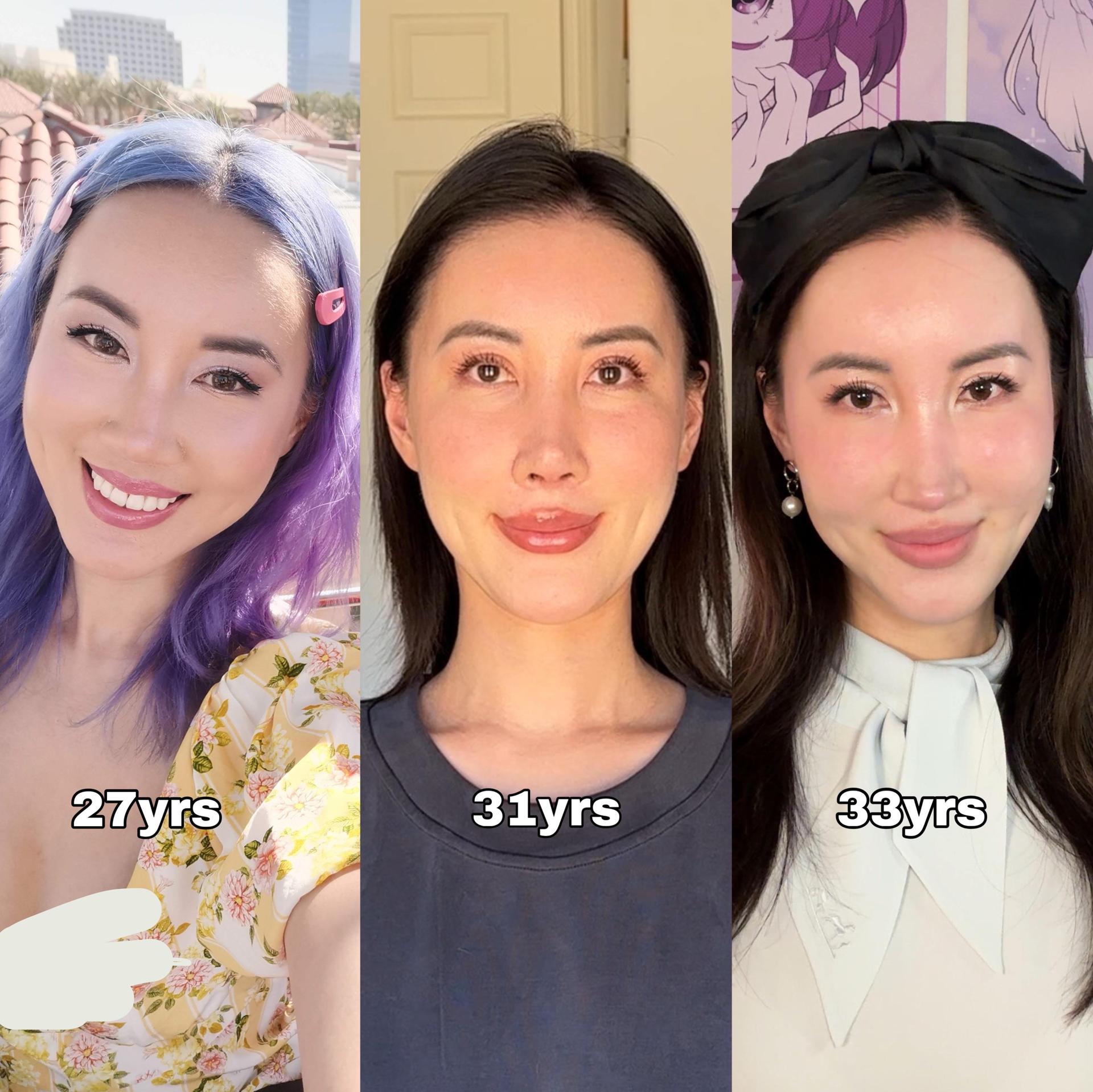Three-image facial timeline shared after four rounds of facial fat transfer