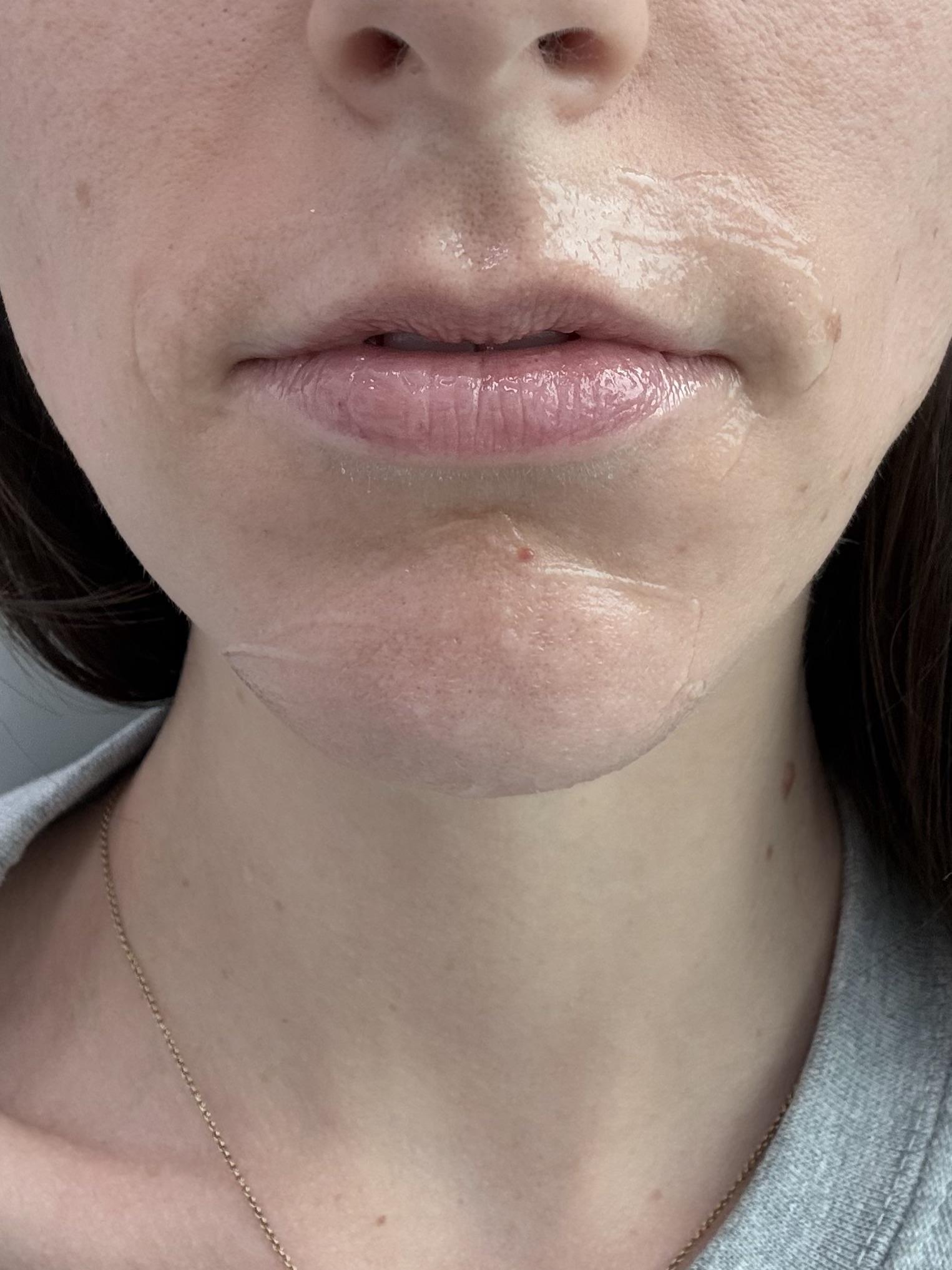 Lips before filler with numbing cream applied, from the patient’s Reddit post