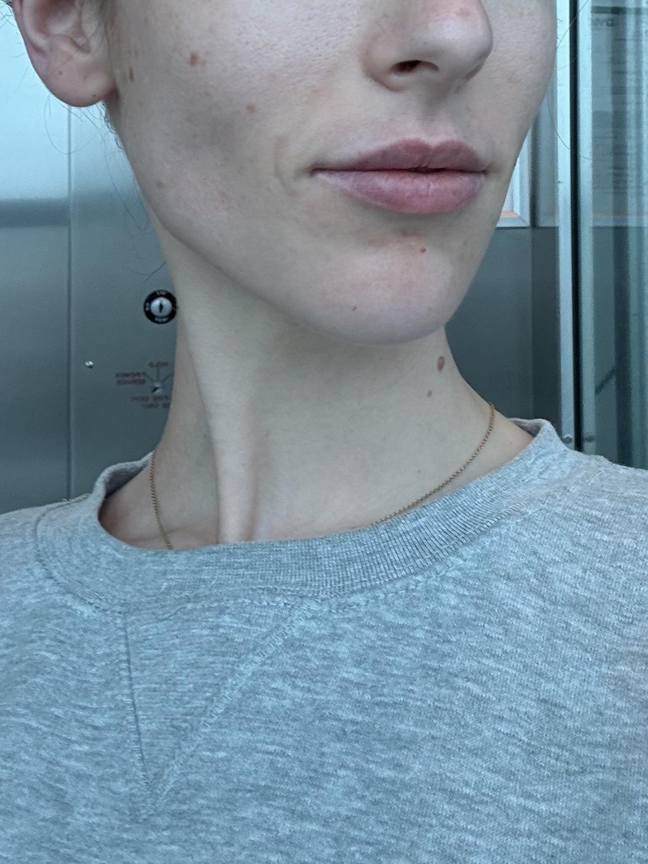 0.5 ml of Lip Filler, First Time: The Exact Appointment