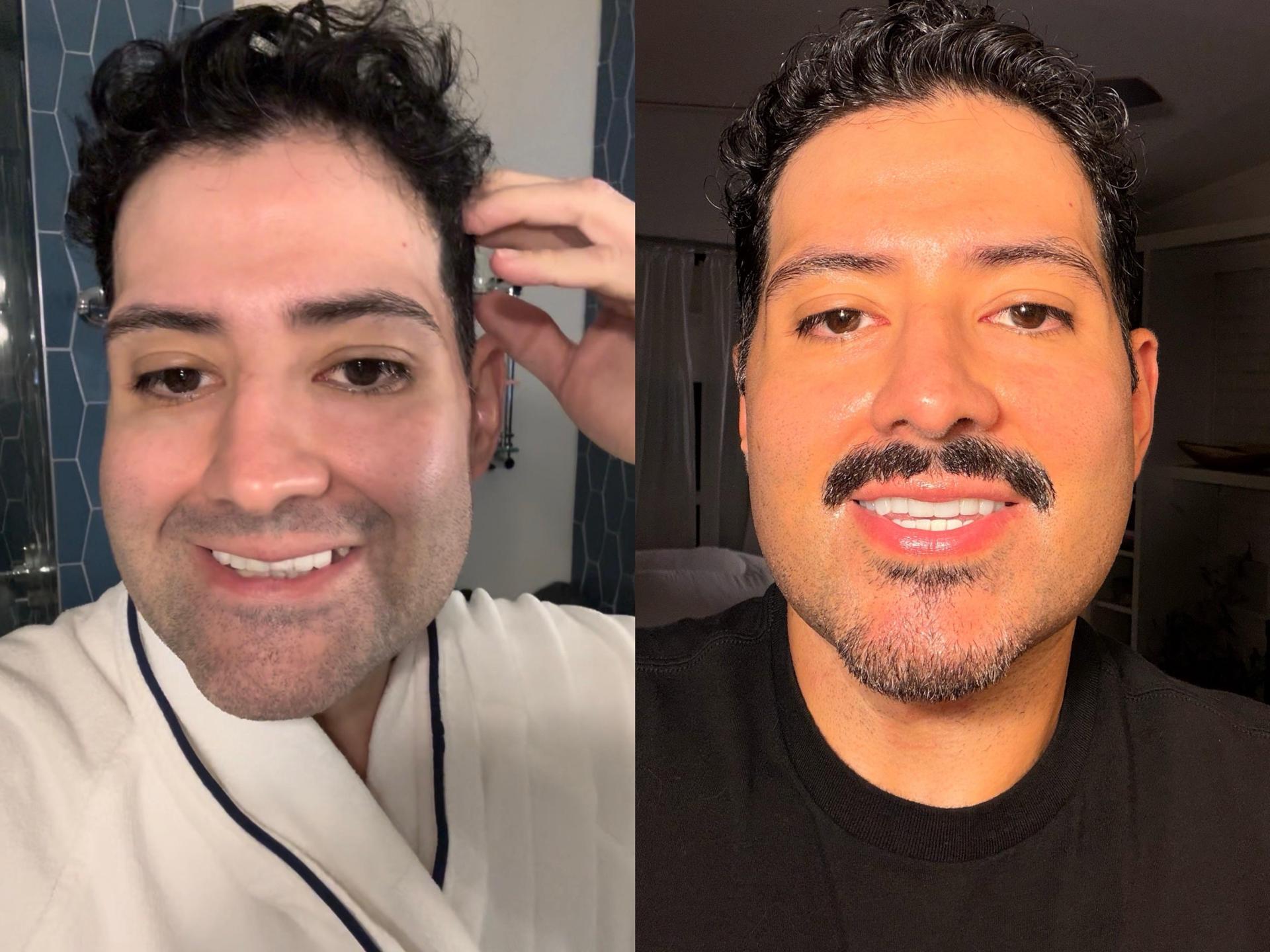 He Lost 180 lbs. The Facelift Cost Over $30k. Here Are the 2-Year Receipts.