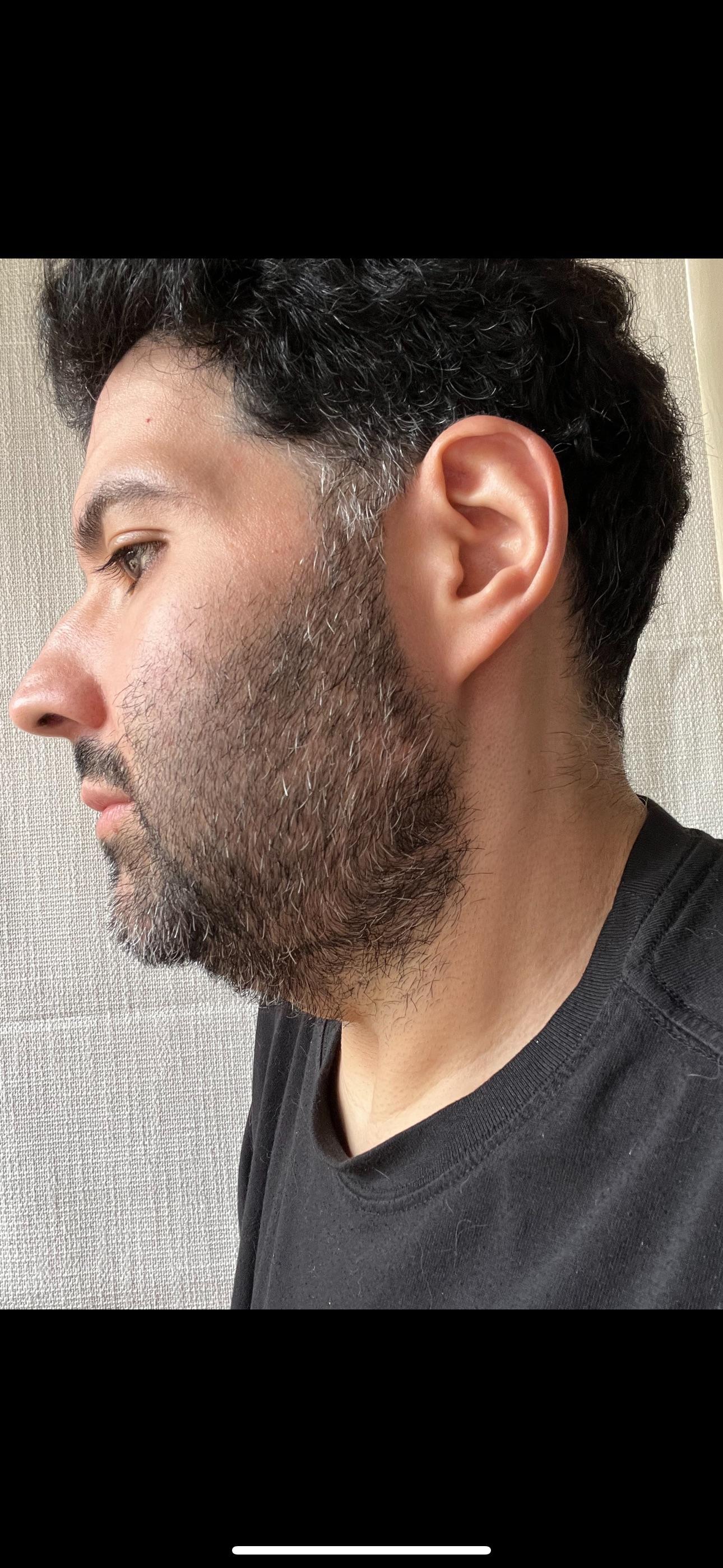 Side profile before facelift showing sagging along the jaw and neck after 180 lb weight loss