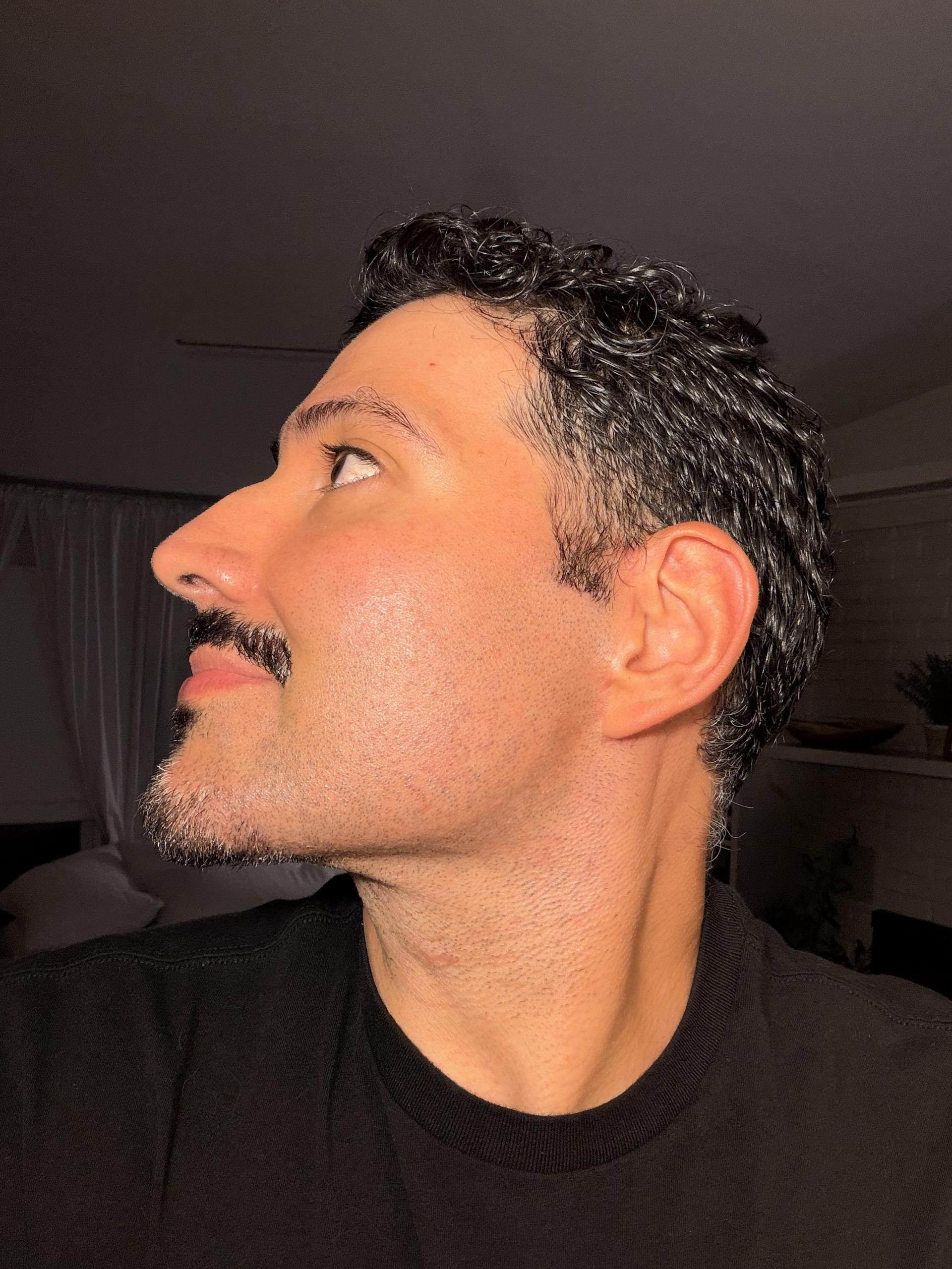 Side profile 2 years after a male facelift showing a defined jawline and neck