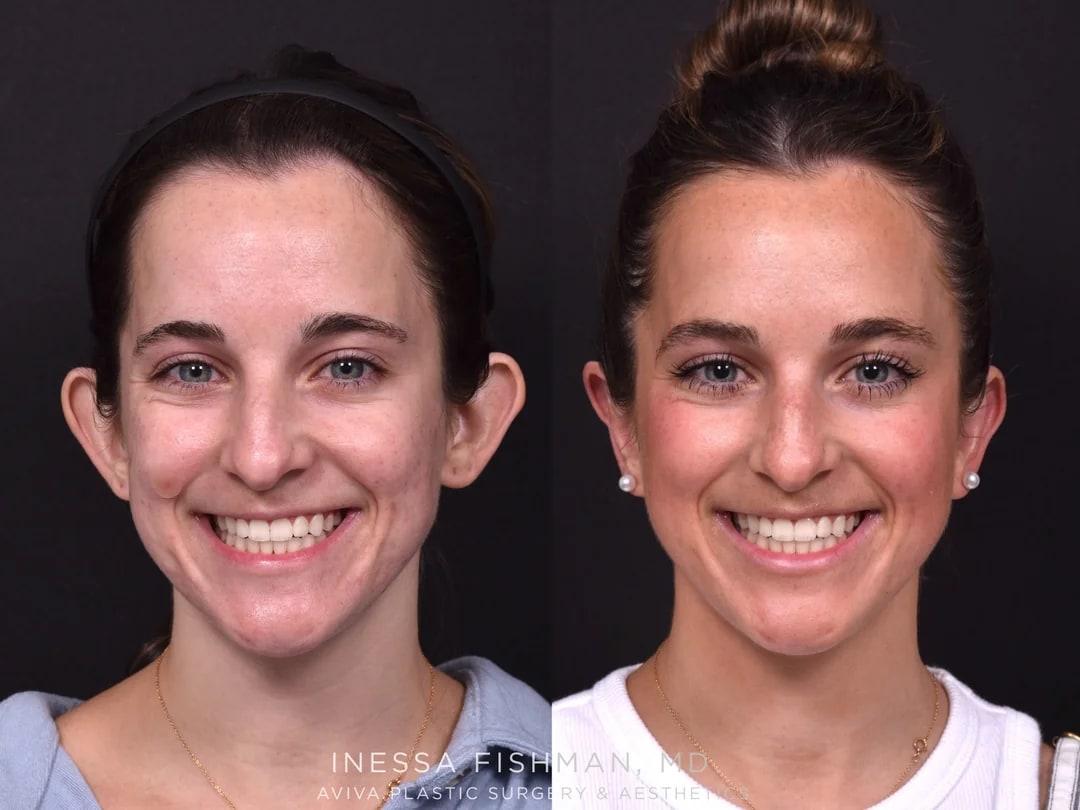 Before-and-after otoplasty comparison for prominent ears