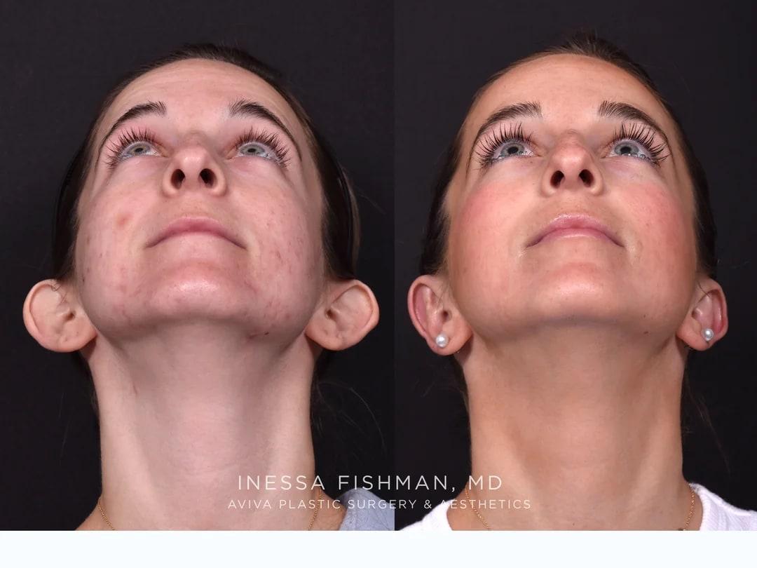 Side and back comparison after otoplasty for prominent ears