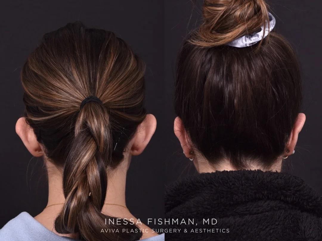 Additional otoplasty before-and-after showing a natural ear position