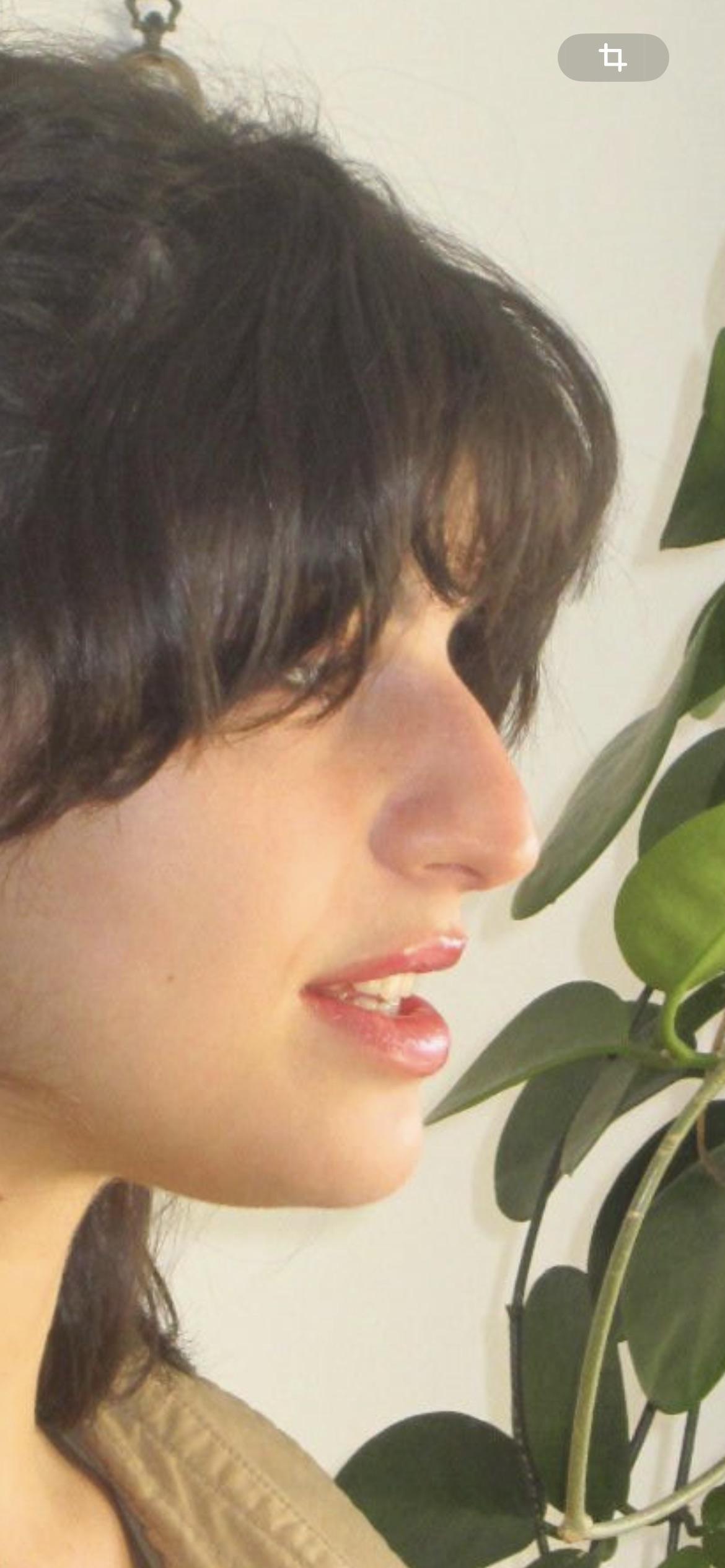 Side profile before rhinoplasty showing a dorsal hump and downturned tip
