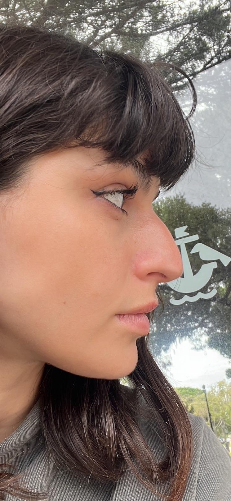 Her Rhinoplasty at 1 Year: 20 Photos, 311 Comments, One Debate