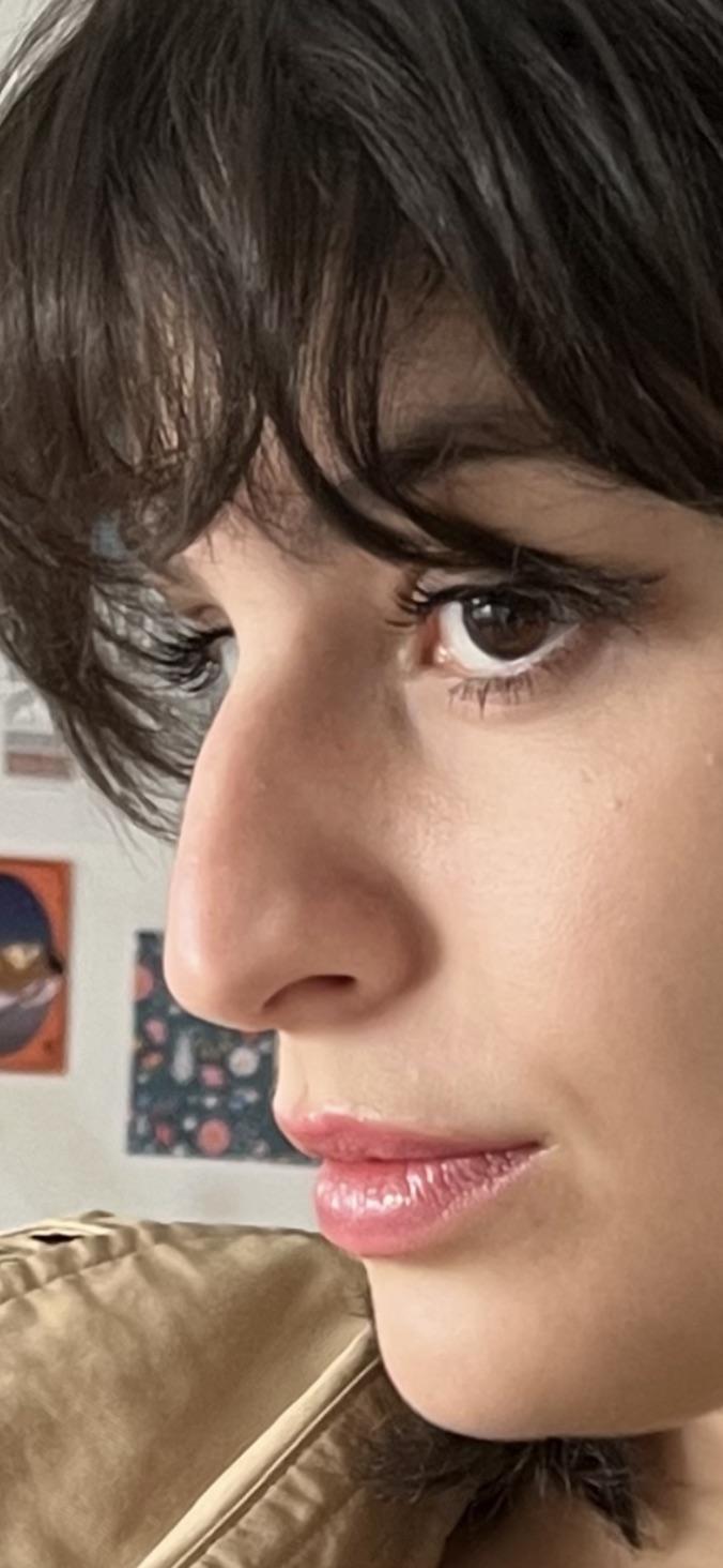 Three-quarter view almost 1 year after rhinoplasty