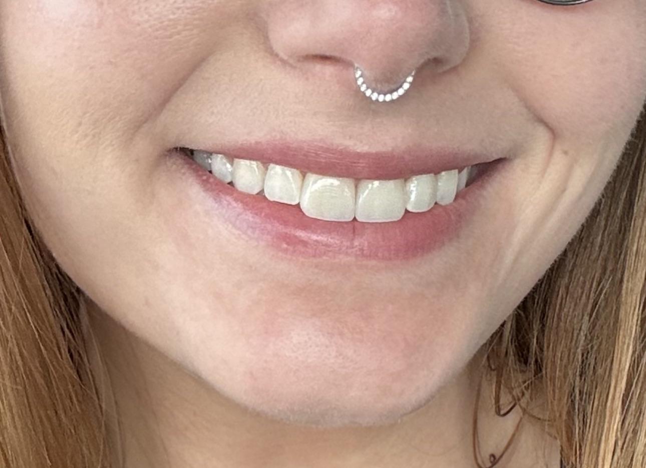 Close-up smile photo from the Reddit veneers update