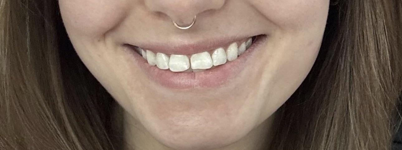 Second smile photo from the Reddit veneers update