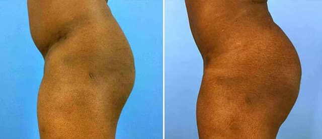 Brazilian Butt Lift result at CosmetiCare Plastic Surgery Newport Beach & Med Spa in Newport Beach, CA