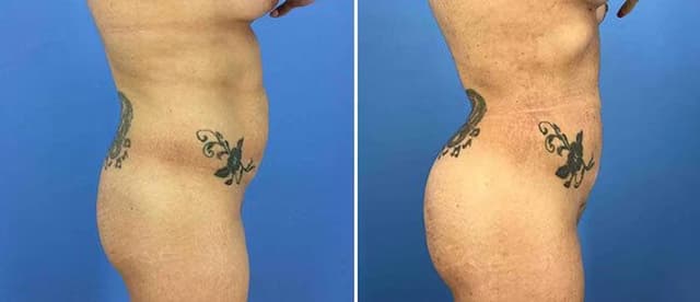 Brazilian Butt Lift result at CosmetiCare Plastic Surgery Newport Beach & Med Spa in Newport Beach, CA