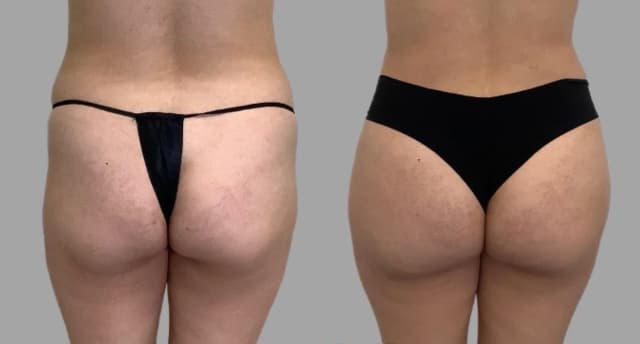 Brazilian Butt Lift result at Pavlo Isak, MD in Newport Beach, CA