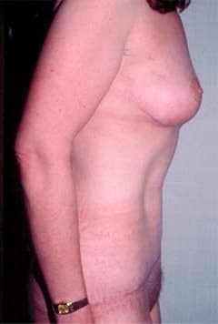 Zellner Plastic Surgery & Dr. Mordcai Blau body lift after — White Plains, NY