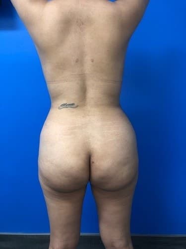 Brazilian Butt Lift after at Ghada Y. Afifi, MD, FACS in Newport Beach, CA
