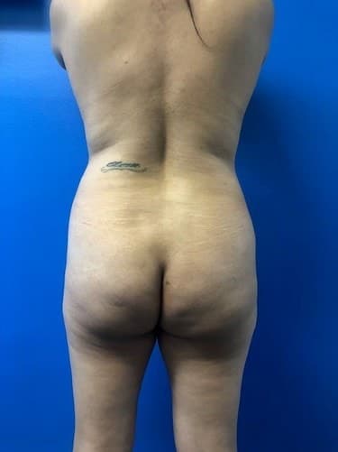 Brazilian Butt Lift before at Ghada Y. Afifi, MD, FACS in Newport Beach, CA