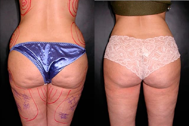 Brazilian Butt Lift result at Gaon Plastic Surgery in Newport Beach, CA